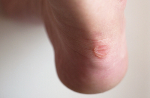 Skavsår på fötterna: orsaker, behandling & förebyggande åtgärder